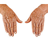   Hände, Haut, Altersflecken